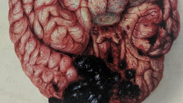 A water-colour of a brain showing a haemorrhage.